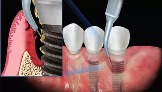 Peri-implant چیست و چگونه با لیزر برطرف می‌شود؟