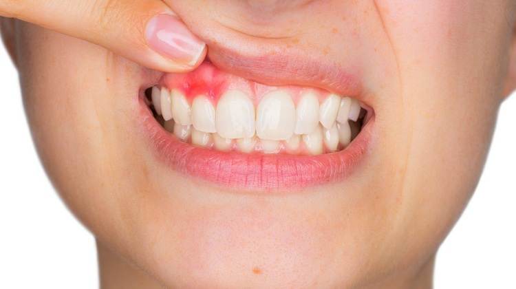 خطرات و عوارض جانبی جراحی لثه