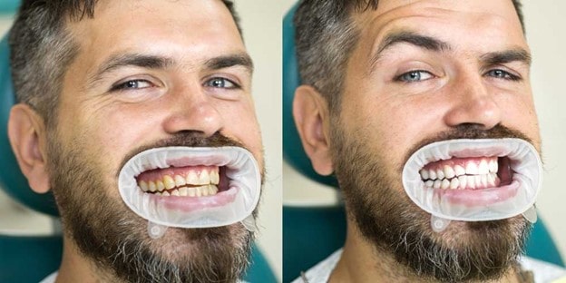 سفید کردن دندان به روش Bleaching