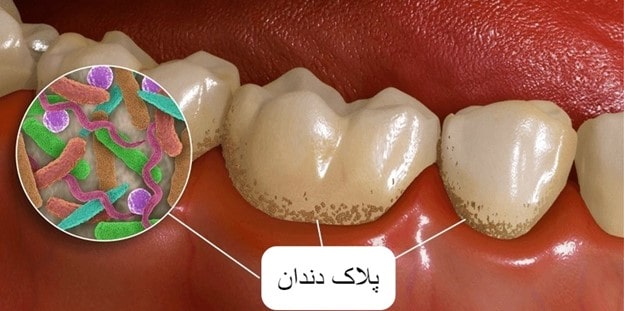 علل پوسیدگی دندان