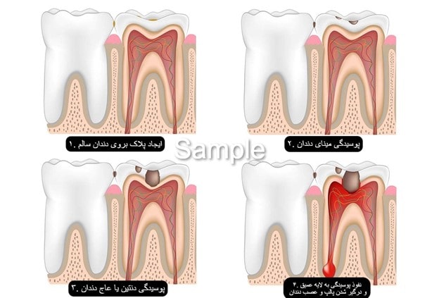 مراحل پوسیدگی دندان کدامند؟