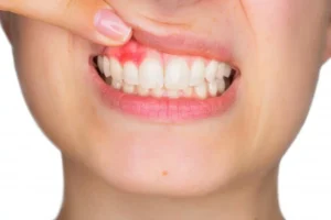 جراحی لثه بدون درد