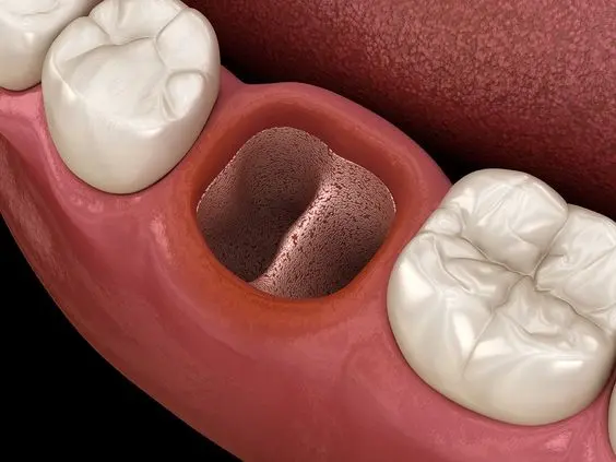 حفره خشک دندان 1 Dry tooth cavity